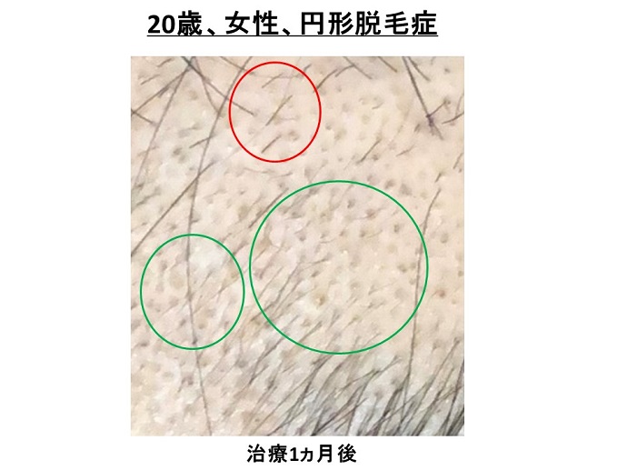 円形脱毛症　病院